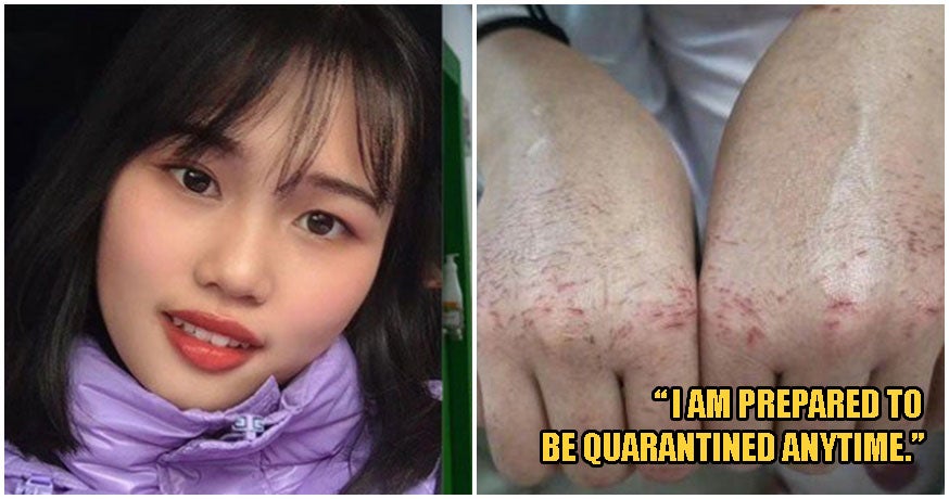 &Quot;The Frontline Needs Me!&Quot; 22Yo Nurse Endures Painful Bloodshot Hands To Treat Wuhan Patients Daily - World Of Buzz 4