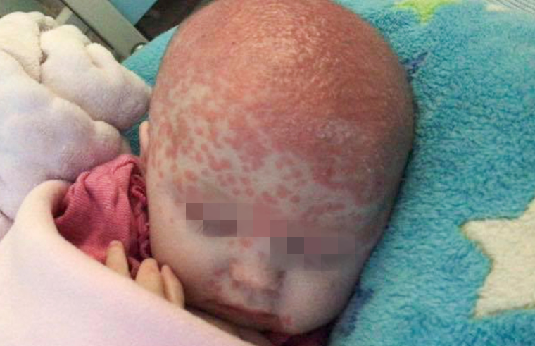 6-Month-Old Baby Gets Infected With Herpes Disease From A Kiss, Almost Leaves Her Blind In One Eye - WORLD OF BUZZ 1