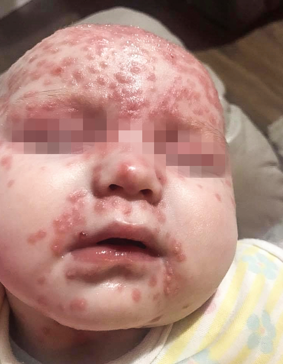 6-Month-Old Baby Gets Infected With Herpes Disease From A Kiss, Almost Leaves Her Blind In One Eye - WORLD OF BUZZ 2