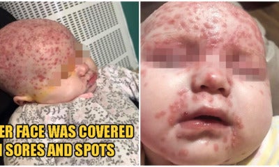 6-Month-Old Baby Gets Infected With Herpes Disease From A Kiss, Almost Leaves Her Blind In One Eye - World Of Buzz 3