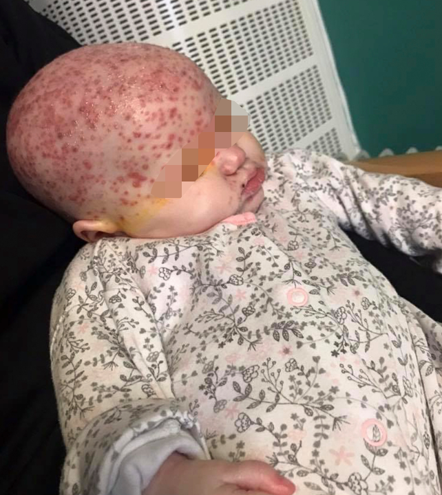 6-Month-Old Baby Gets Infected With Herpes Disease From A Kiss, Almost Leaves Her Blind In One Eye - WORLD OF BUZZ