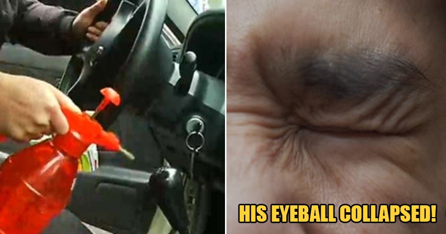 Man Uses Pressurized Water Can With 75% Alcohol To Disinfect Car, Suffers Severe Eyeball Injury - World Of Buzz