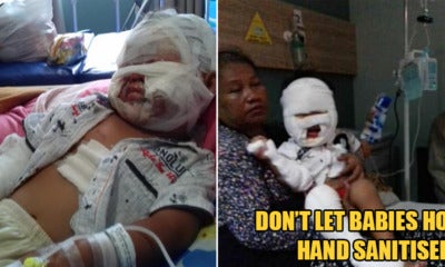 3yo Girl Suffers Burns On Body After Holding Hand Sanitiser Bottle Near An Open Flame - WORLD OF BUZZ