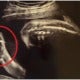Baby In Mother'S Womb Shows Peace Sign During Ultrasound, Reassures Worried Mum - World Of Buzz 1