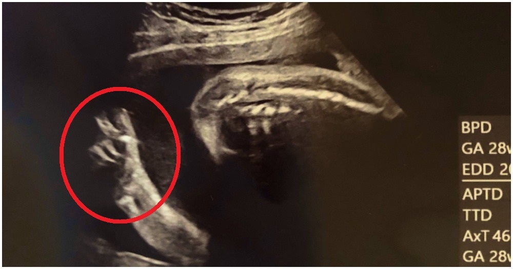 Baby In Mother'S Womb Shows Peace Sign During Ultrasound, Reassures Worried Mum - World Of Buzz 1