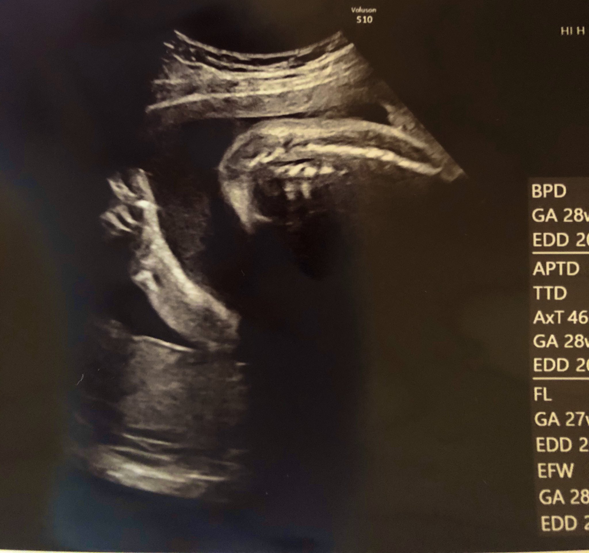 Baby in Mother's Womb Shows Peace Sign During Ultrasound, Reassures Worried Mum - WORLD OF BUZZ