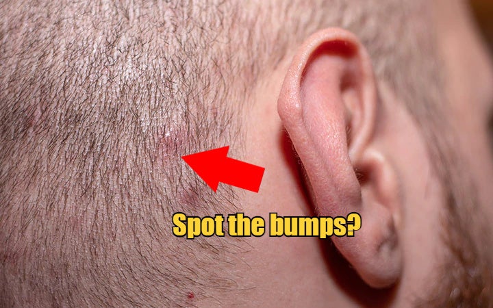 side view with ear in shot of a man with short hair suffering from scalp acne.jpg