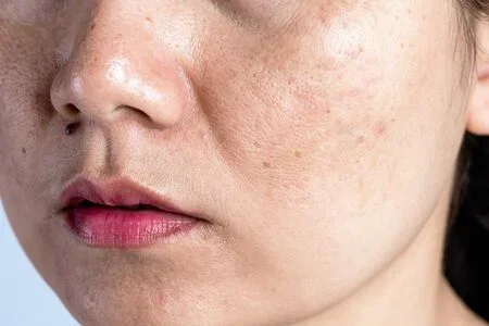 130210559 woman with problematic skin and acne scars problem skincare and health concept wrinkles dark spots f