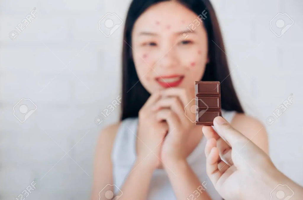 119662872 Young Asian Woman Acne Problem Face With Chocolate Bar But Happy Eating