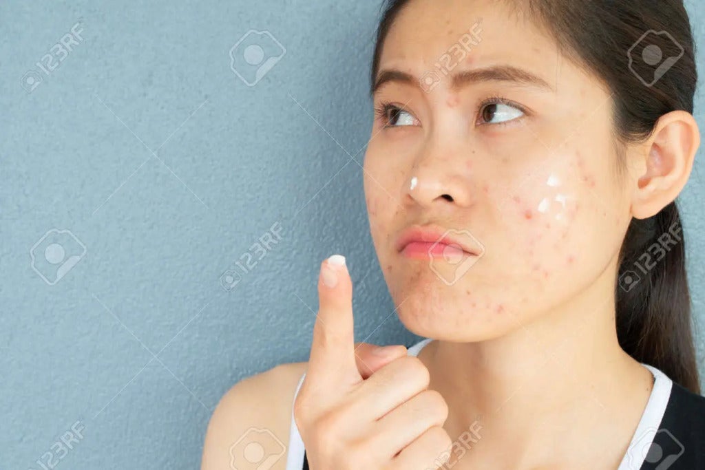 181648372 Portrait Of Woman With Acne Inflammation Papule And Pustule On Her Face And She Applying Acne