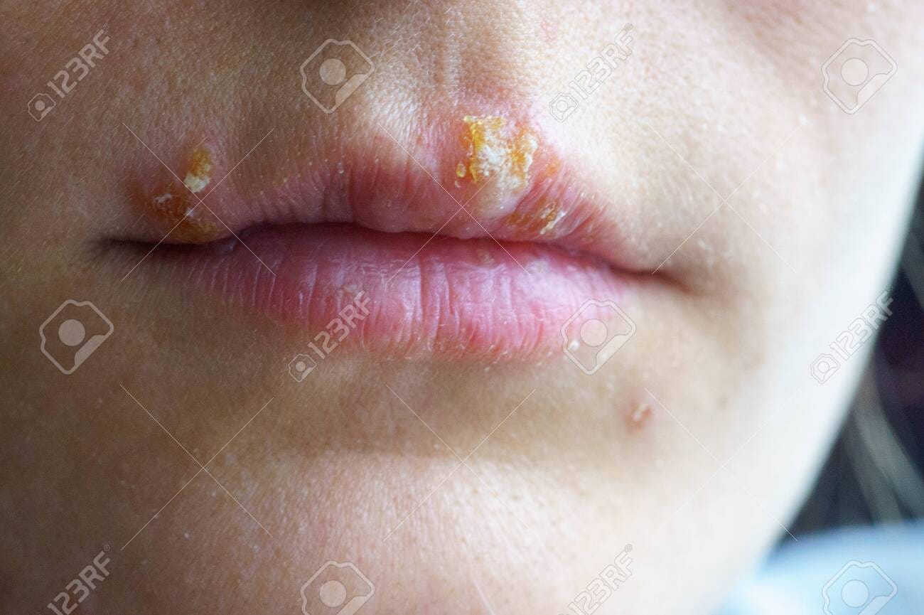 147828601 Herpes Disease On The Lips Of A Young Girl Wounds From Herpes On The Lips Of A Person Herpes Foci