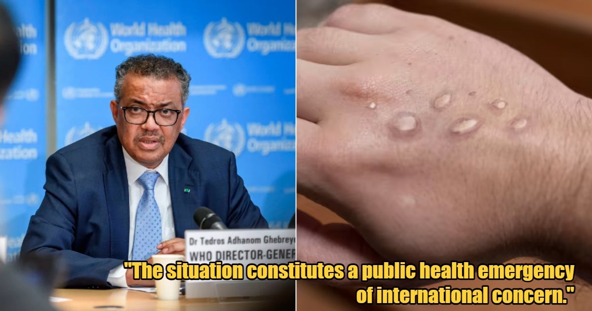 WHO Monkeypox is Now an International Health Emergency, 925 Cases & 11