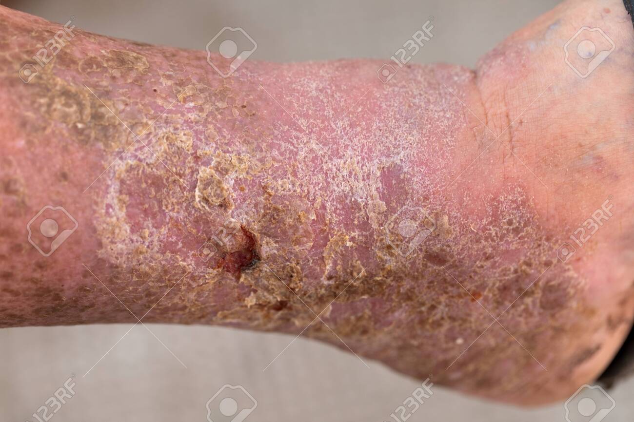 150931377 Close Up Picture Of An Infected Wound On Foot