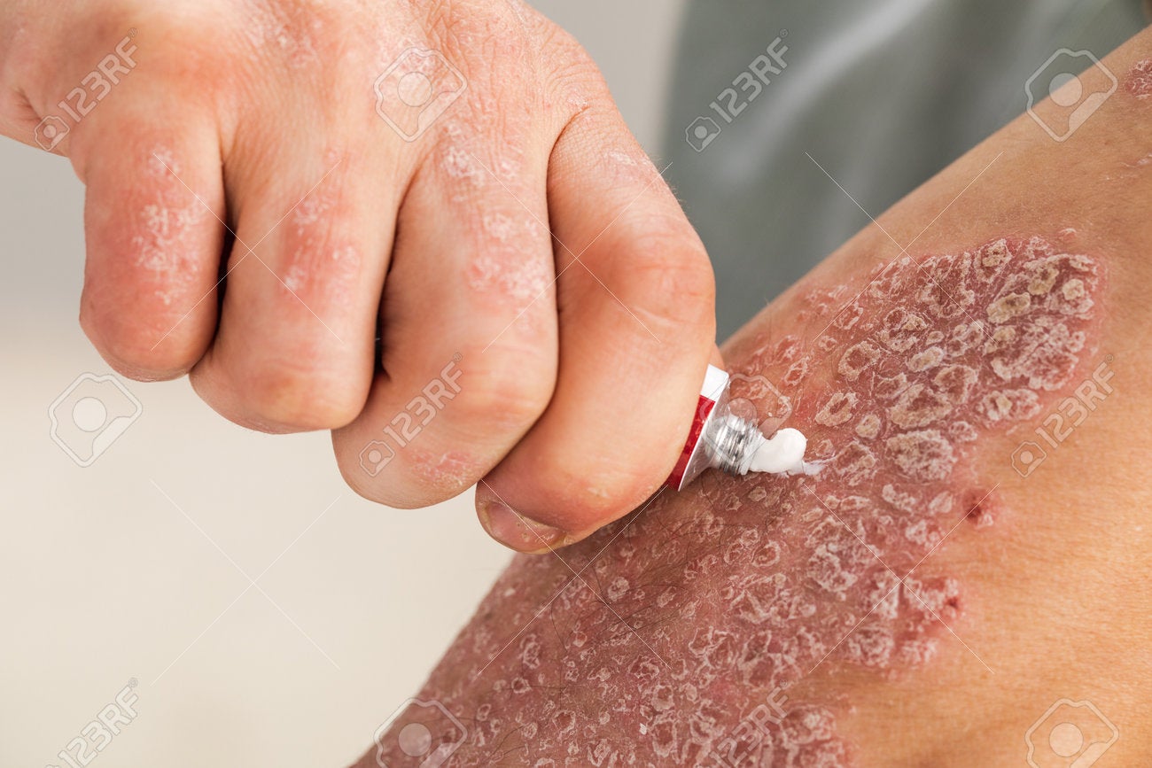 158074657 The Use Of Emollient For Dry Flaky Skin As In The Treatment Of Psoriasis Eczema And Other Diseases