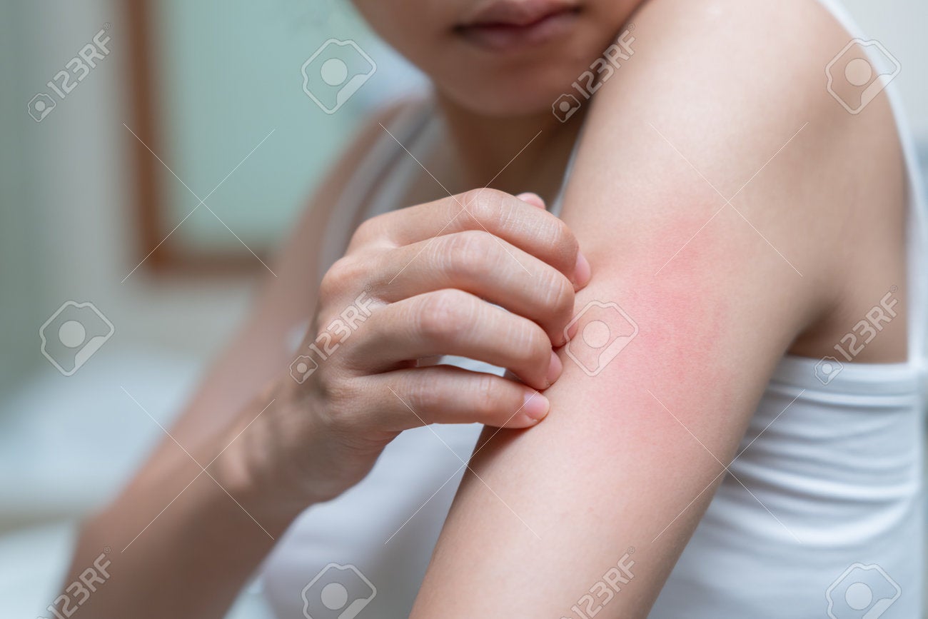 207919975 Skin Problem And Beauty Young Woman Scratch Body Has Itchy Skin From Skin Allergic Steroid Allergy
