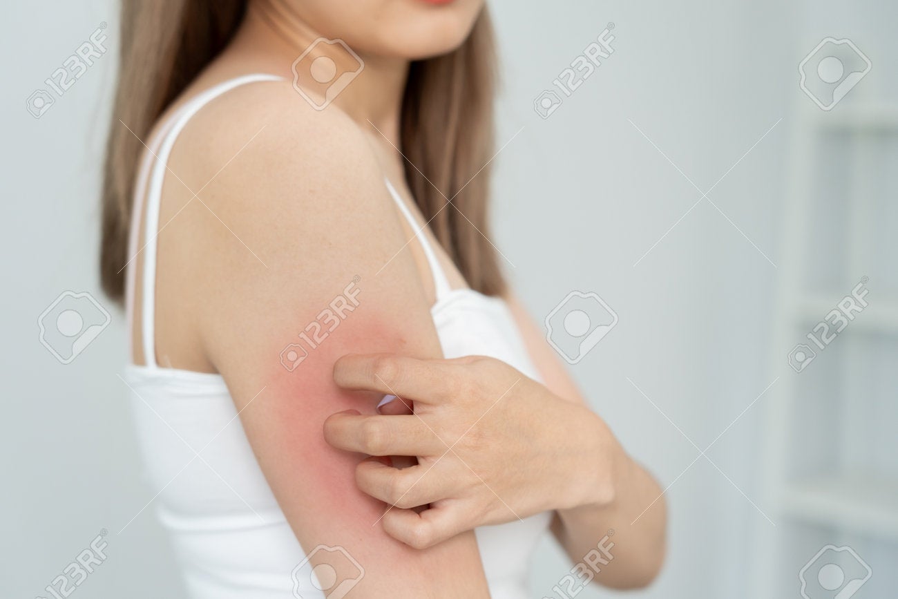 211438676 Skin Problem And Beauty Young Woman Scratch Body Has Itchy Skin From Skin Allergic Steroid Allergy
