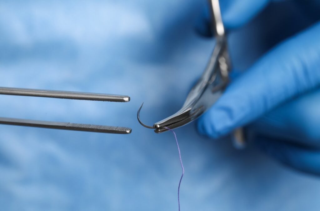 Thai Woman Endures 18 Years of Pain Only to Discover a Needle Was Left ...