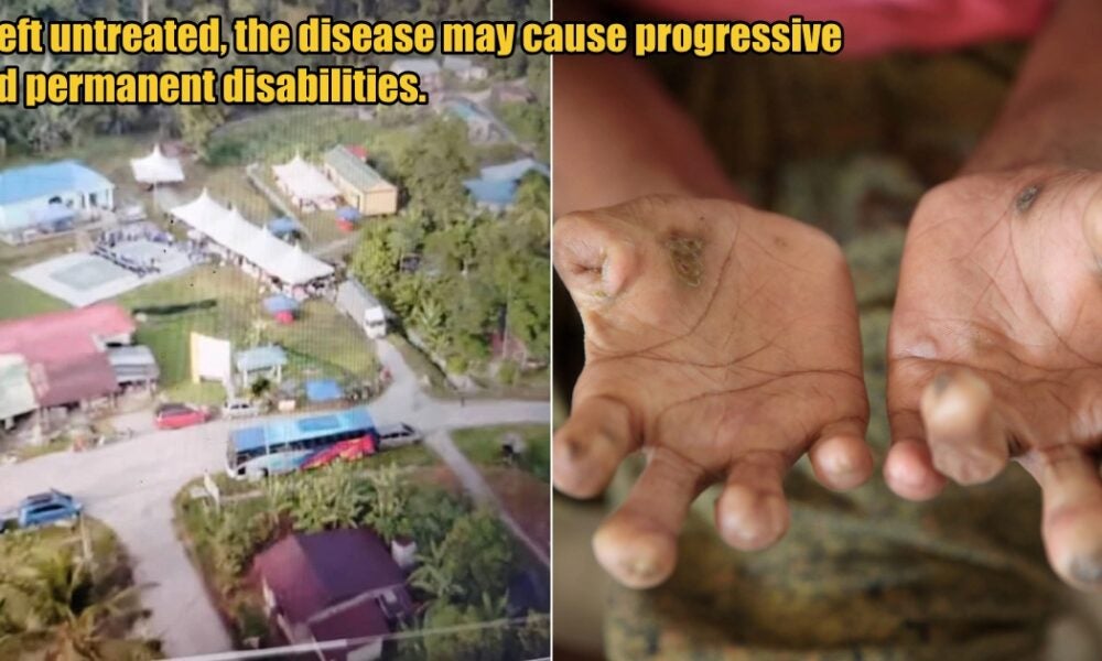 2 Orang Asli Villages in Kuala Pilah Placed Under Quarantine After 18yo Girl Dies Following Leprosy Outbreak