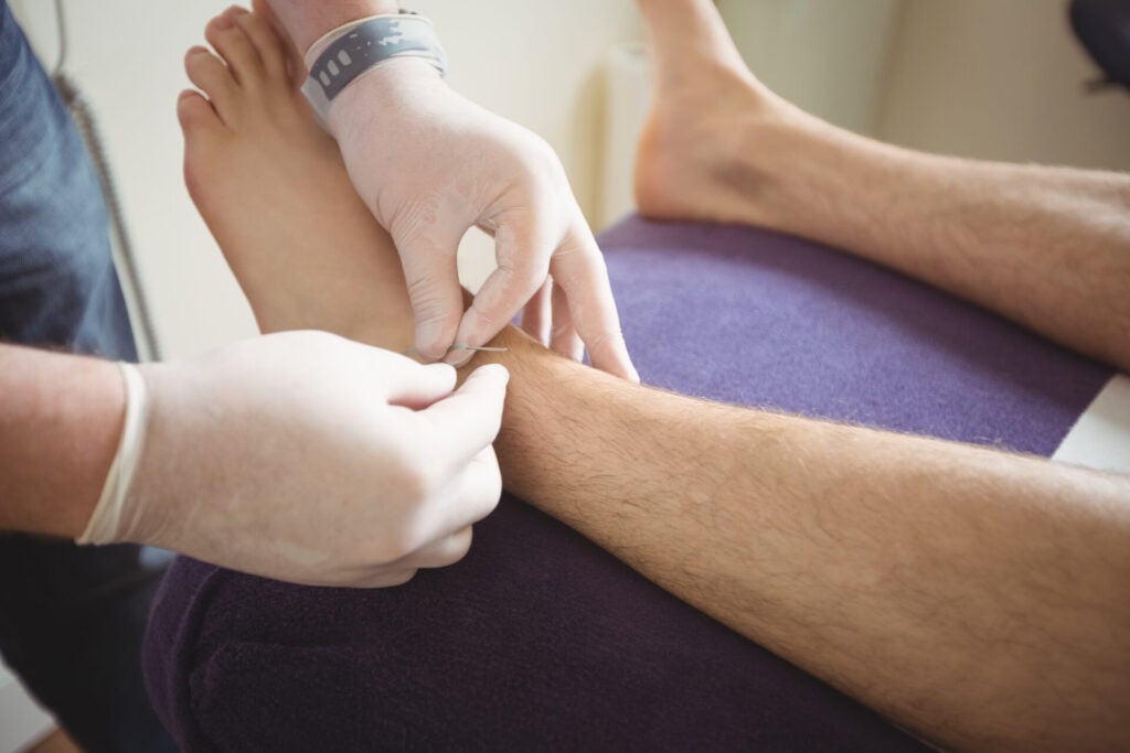 physiotherapist performing dry needling leg patient