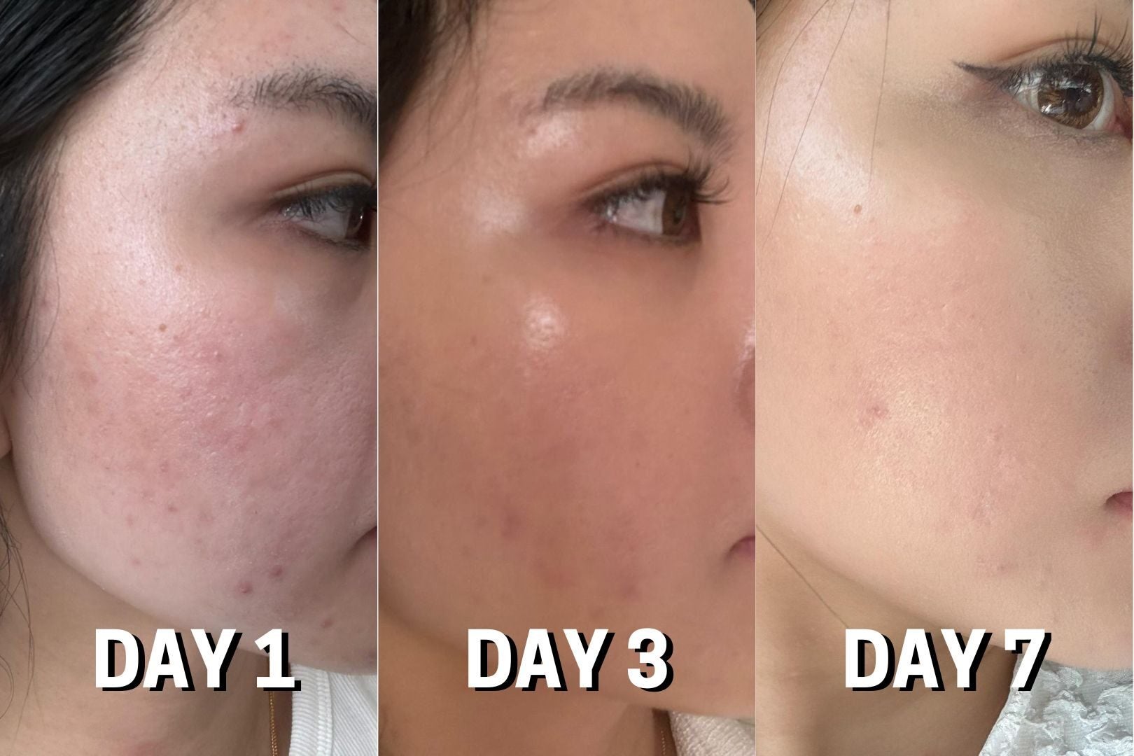 EucerinProACNEQ2 Before after ssshiyi